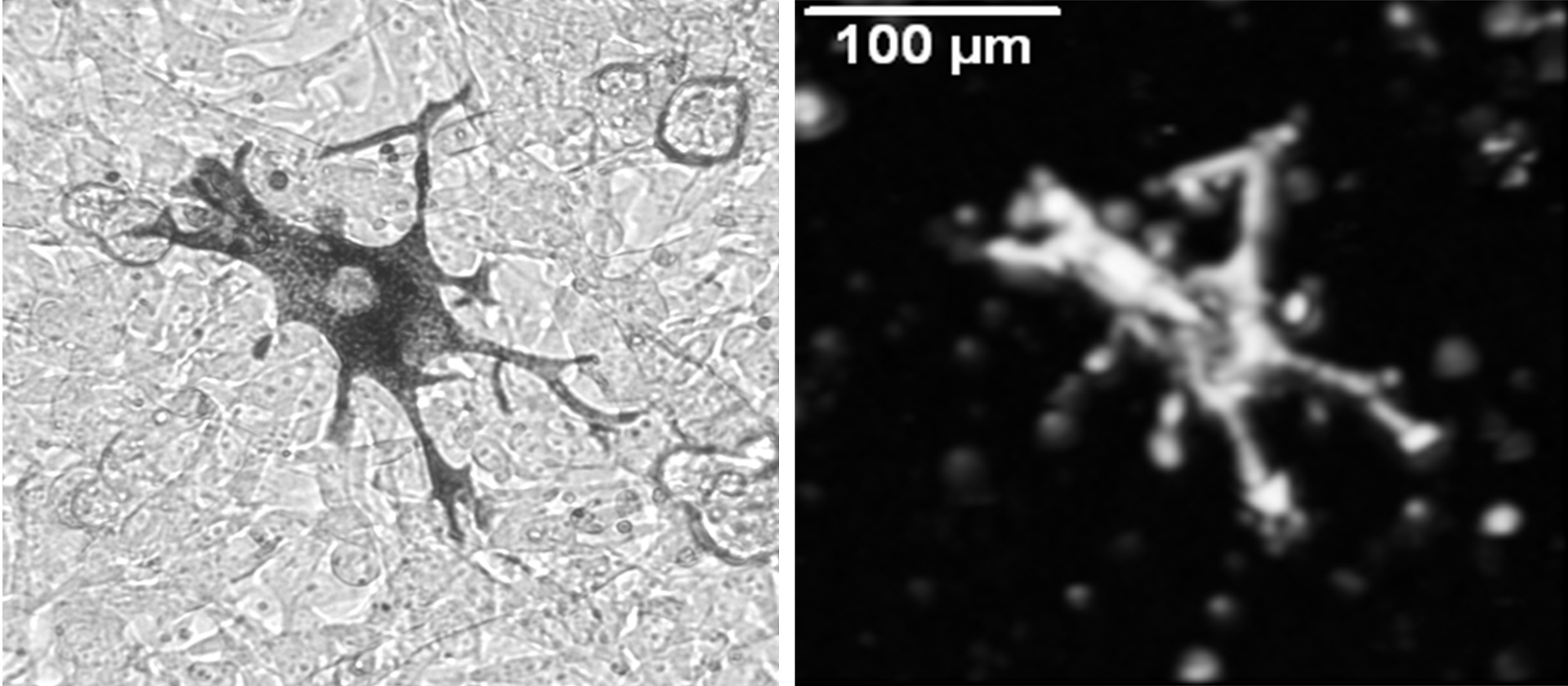 Photoacoustic imaging of melanoma cells